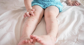 A young child on the bed with mosquito bites all over her legs